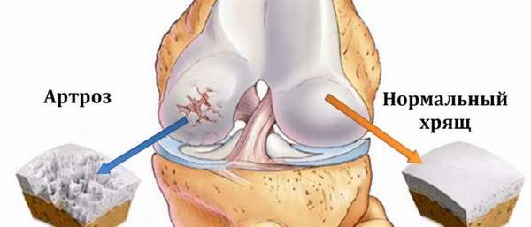 Снять воспаление при артрозе коленного сустава thumbnail